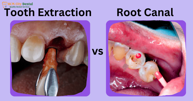 Root Canal vs Tooth Removal: Which is Right for You? | Dr. Cuong