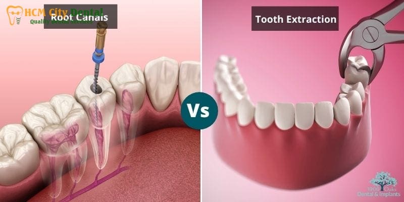 root-canal-vs-tooth-removal-3-dr-cuong-hcmc-dental-clinic-dr-cuong-hcmc-dental-clinic