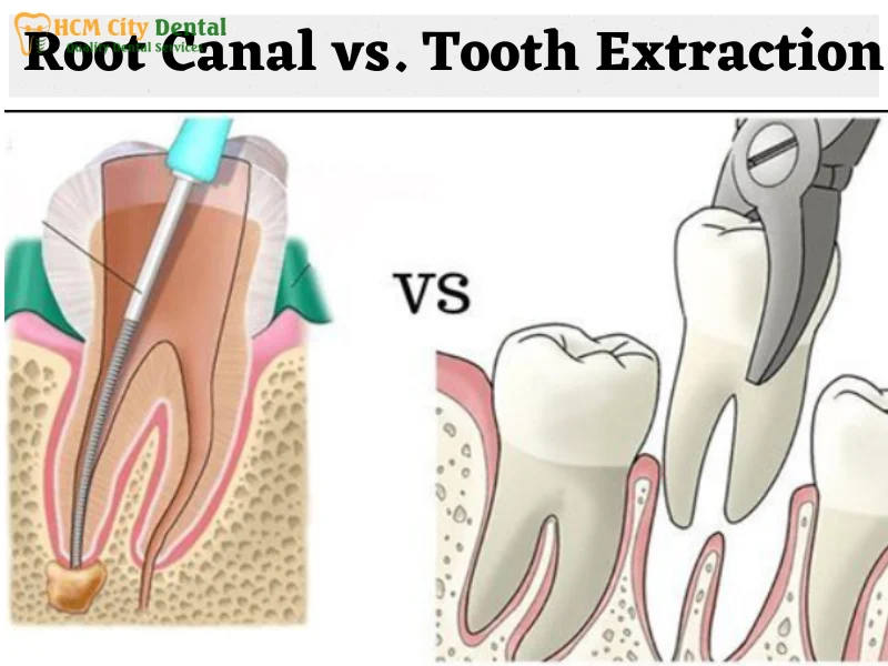 root-canal-vs-tooth-removal-4-dr-cuong-hcmc-dental-clinic-dr-cuong-hcmc-dental-clinic