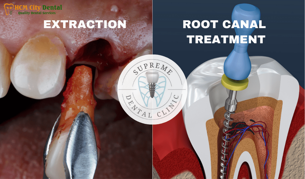 root-canal-vs-tooth-removal-6-dr-cuong-hcmc-dental-clinic-dr-cuong-hcmc-dental-clinic