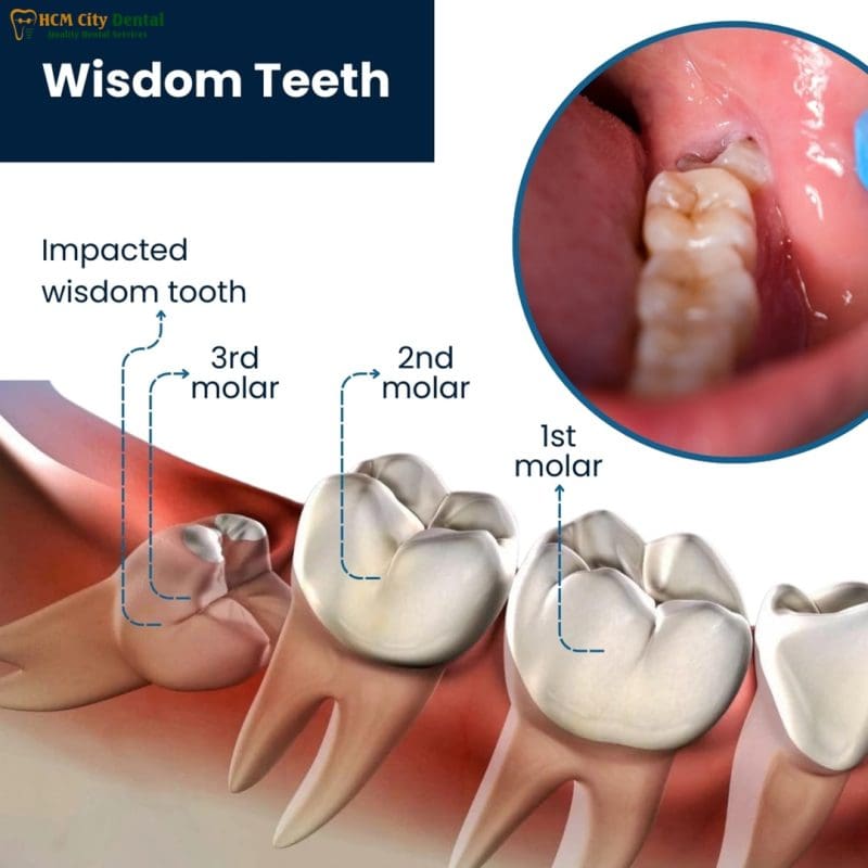 Should Wisdom Teeth Be Removed? [The Truth You Need] | Dr. Cuong