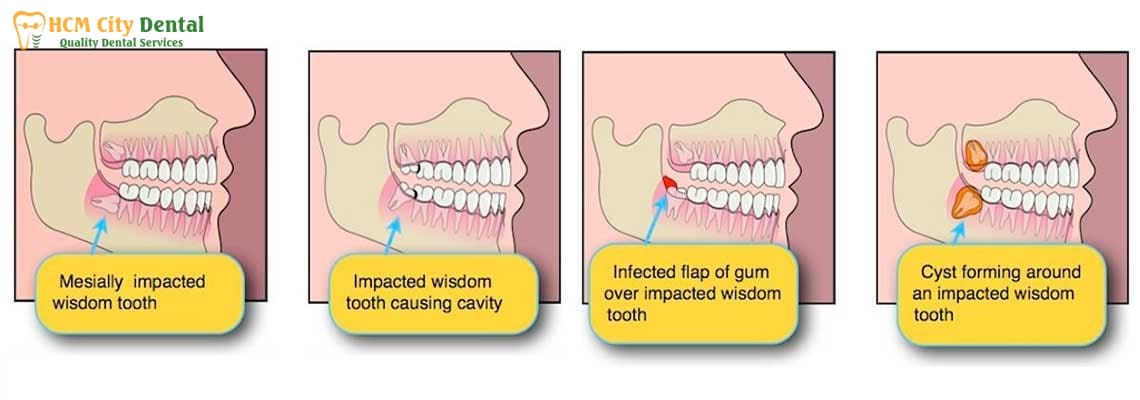 should-wisdom-teeth-be-removed-2-dr-cuong-hcmc-dental-clinic-dr-cuong-hcmc-dental-clinic