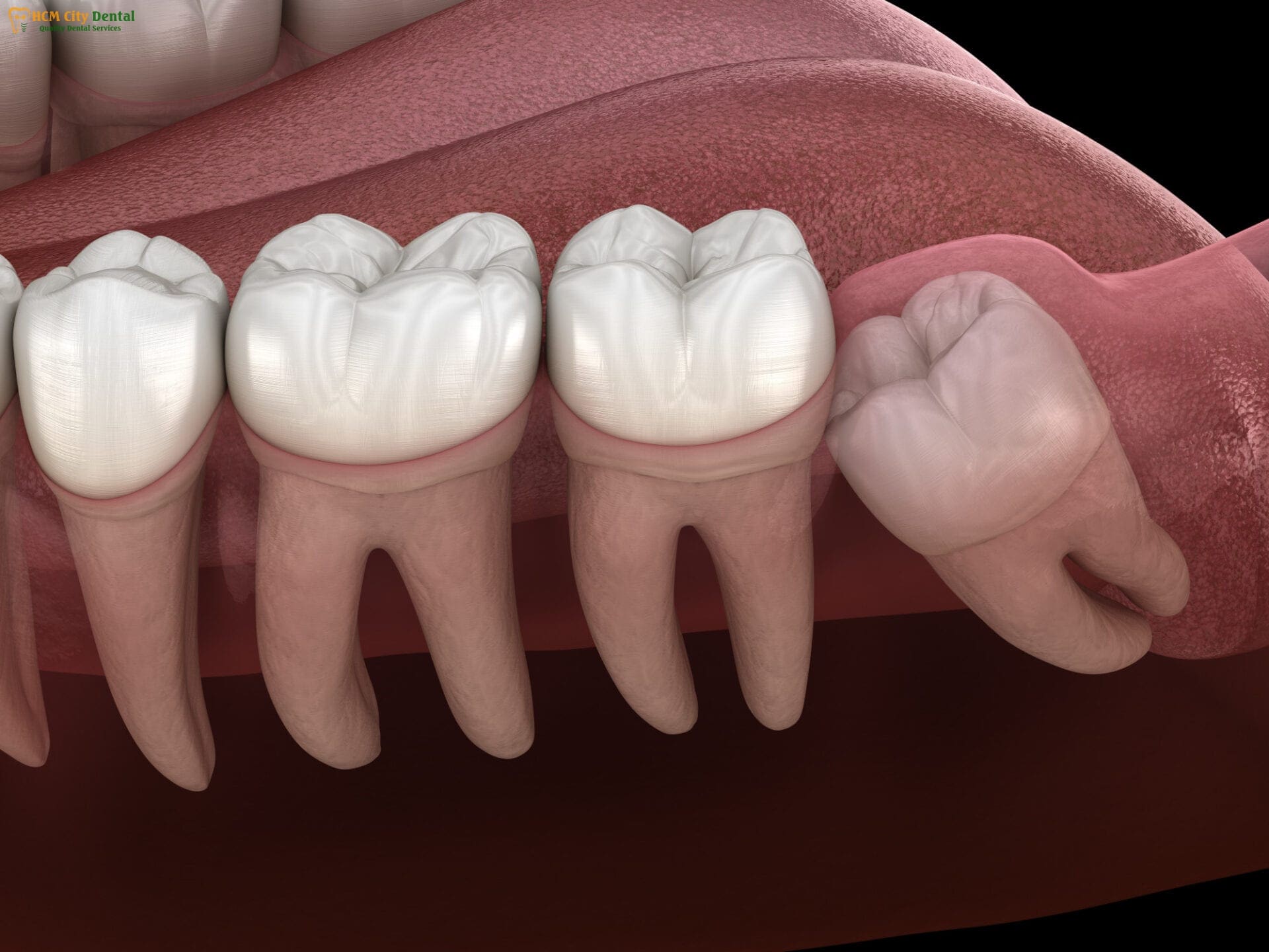 should-wisdom-teeth-be-removed-3-dr-cuong-hcmc-dental-clinic-dr-cuong-hcmc-dental-clinic