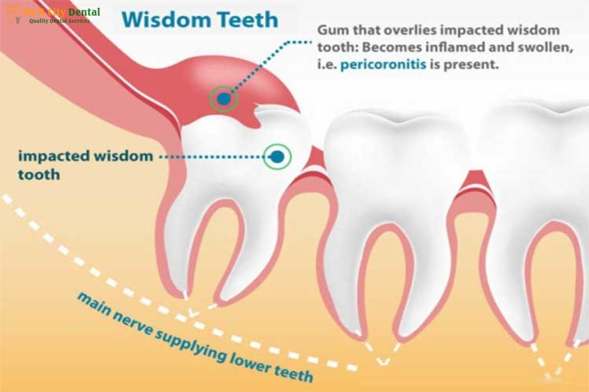 should-wisdom-teeth-be-removed-4-dr-cuong-hcmc-dental-clinic-dr-cuong-hcmc-dental-clinic