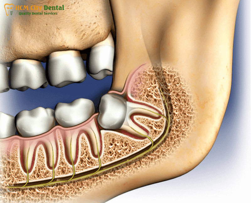 should-wisdom-teeth-be-removed-5-dr-cuong-hcmc-dental-clinic-dr-cuong-hcmc-dental-clinic