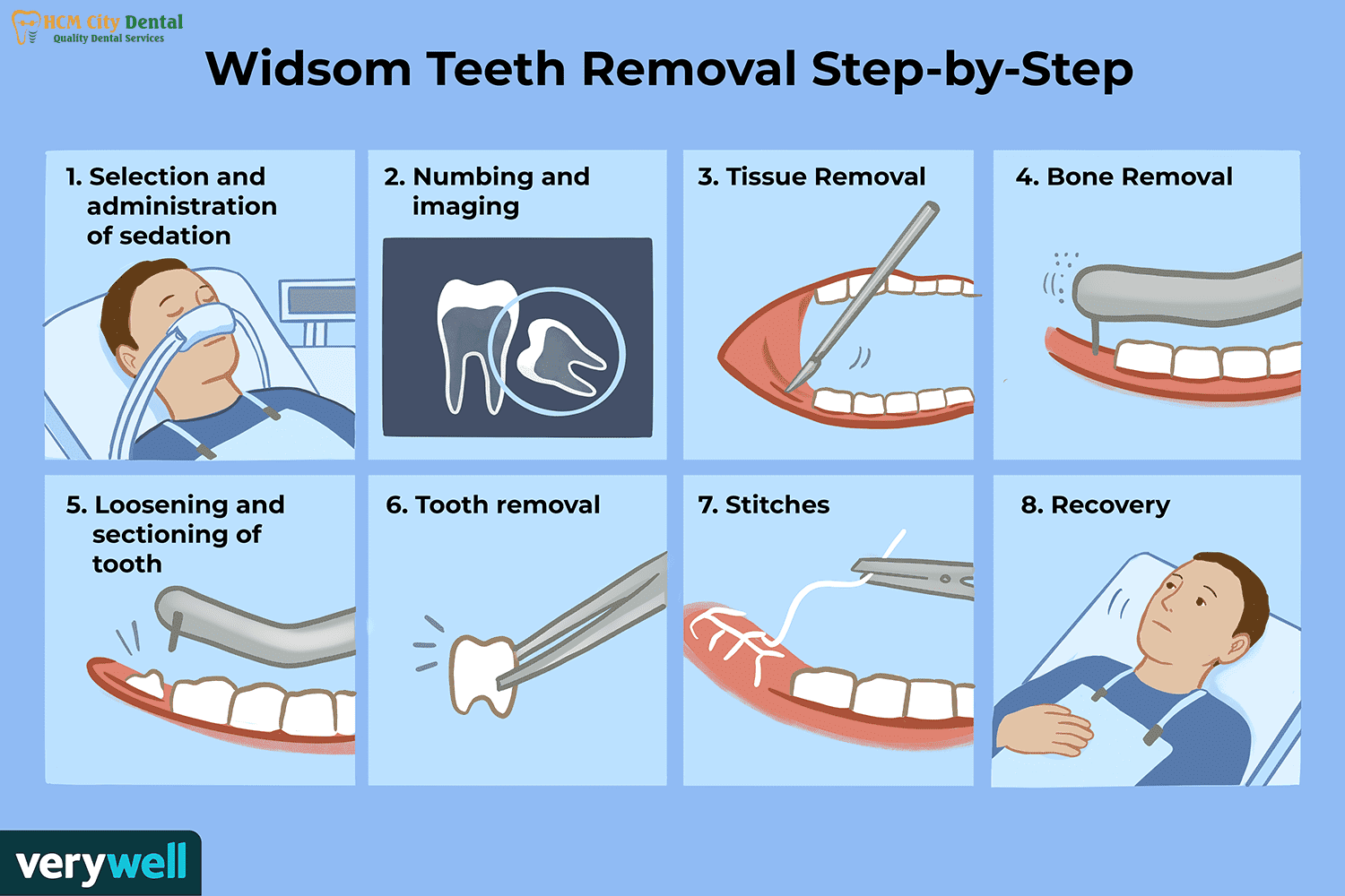 should-wisdom-teeth-be-removed-6-dr-cuong-hcmc-dental-clinic-dr-cuong-hcmc-dental-clinic