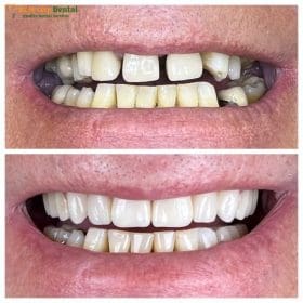 Same-Day Express Acrylic & Metal Denture Repair, Relining & Rebasing in Ho Chi Minh City (2–4 Hour Turnaround) at HCMC Dental Clinic