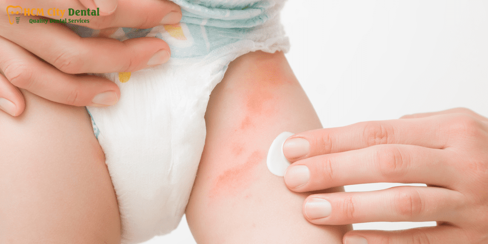teething-diaper-rash-2-dr-cuong-hcmc-dental-clinic-dr-cuong-hcmc-dental-clinic