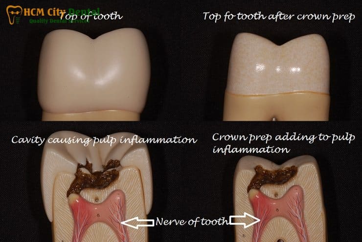 Why Does Your Tooth Crown Pain? [Expert Solutions] | Dr. Cuong