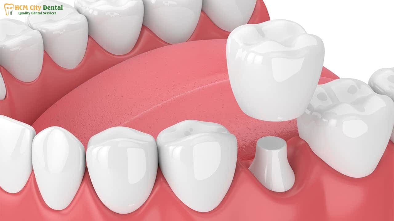 tooth-crown-pain-2-dr-cuong-hcmc-dental-clinic-dr-cuong-hcmc-dental-clinic