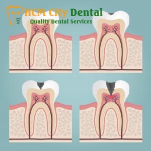 tooth-crown-pain-4-dr-cuong-hcmc-dental-clinic-dr-cuong-hcmc-dental-clinic