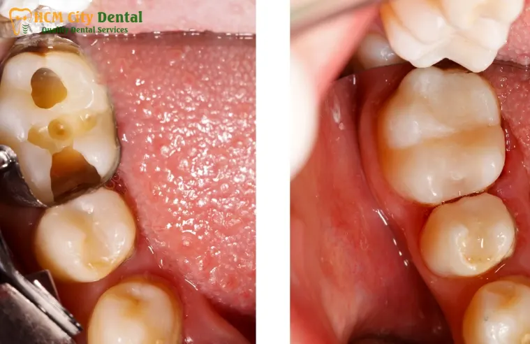 tooth-crown-pain-6-dr-cuong-hcmc-dental-clinic-dr-cuong-hcmc-dental-clinic