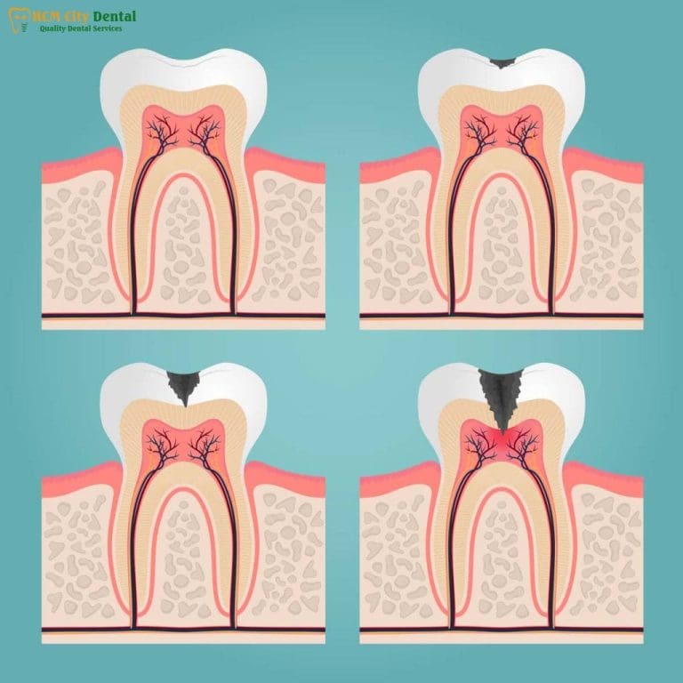 Tooth Decay and Bad Breath: 7 Simple Solutions for Fresh Breath | Dr. Cuong