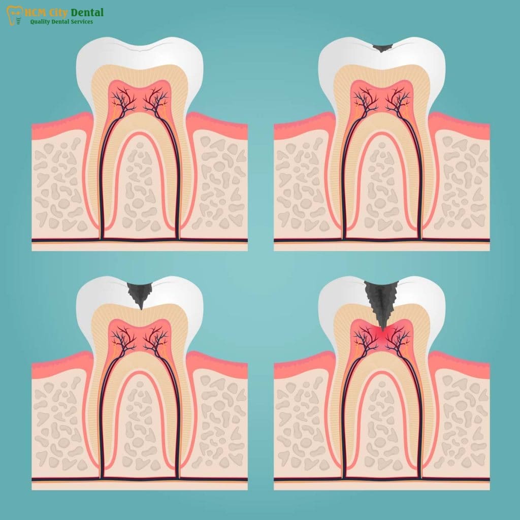 tooth-decay-and-bad-breath-1-dr-cuong-hcmc-dental-clinic-dr-cuong-hcmc-dental-clinic