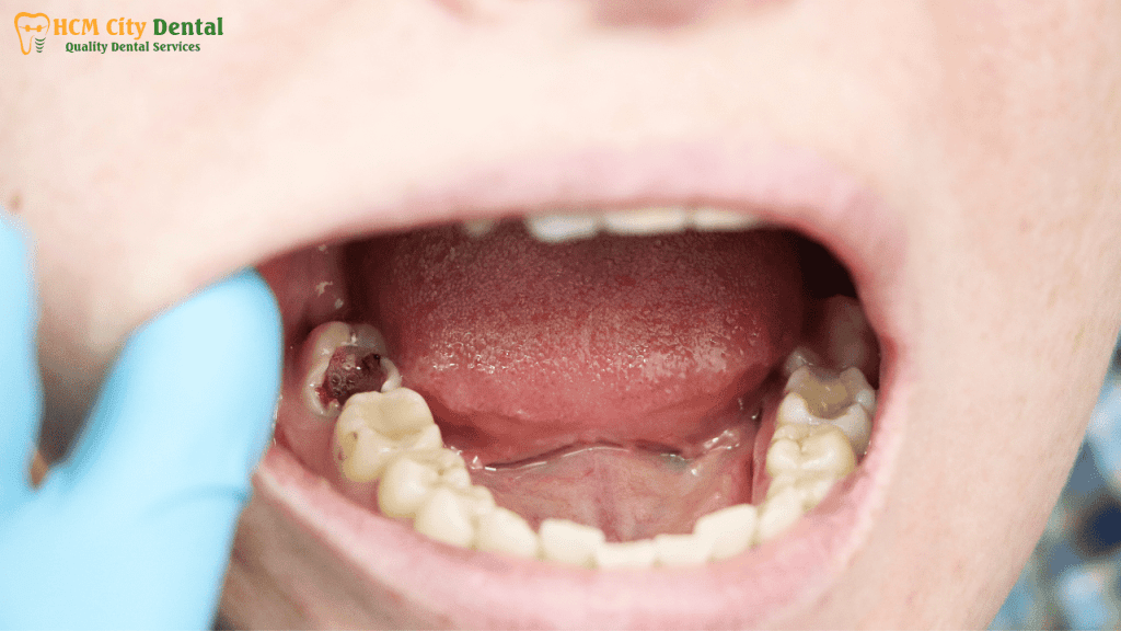 tooth-decay-and-bad-breath-3-dr-cuong-hcmc-dental-clinic-dr-cuong-hcmc-dental-clinic