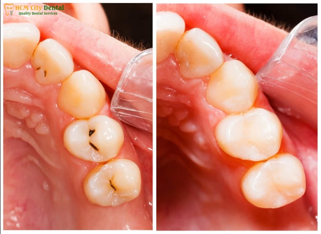 tooth-decay-and-bad-breath-4-dr-cuong-hcmc-dental-clinic-dr-cuong-hcmc-dental-clinic