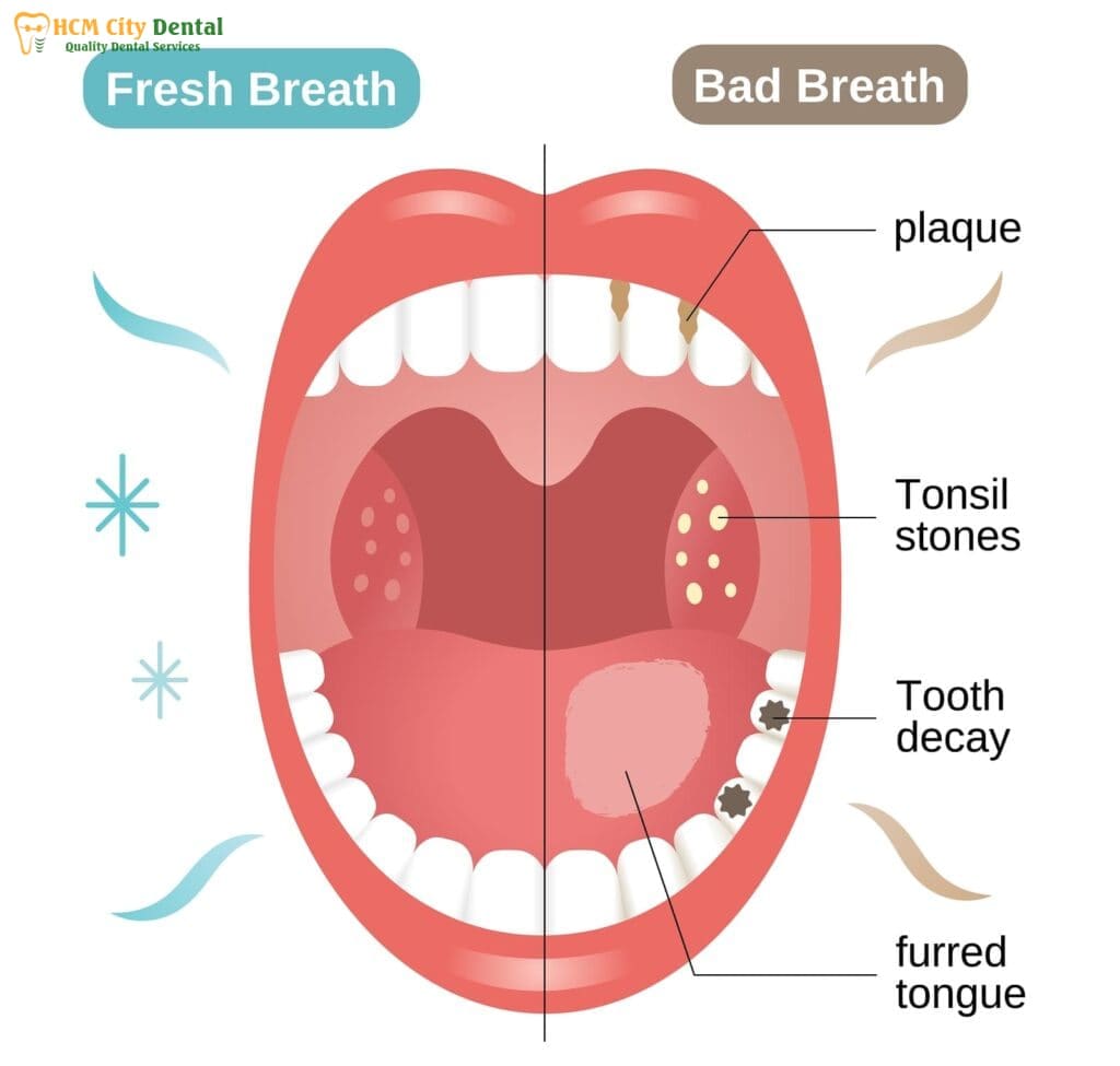 tooth-decay-and-bad-breath-5-dr-cuong-hcmc-dental-clinic-dr-cuong-hcmc-dental-clinic