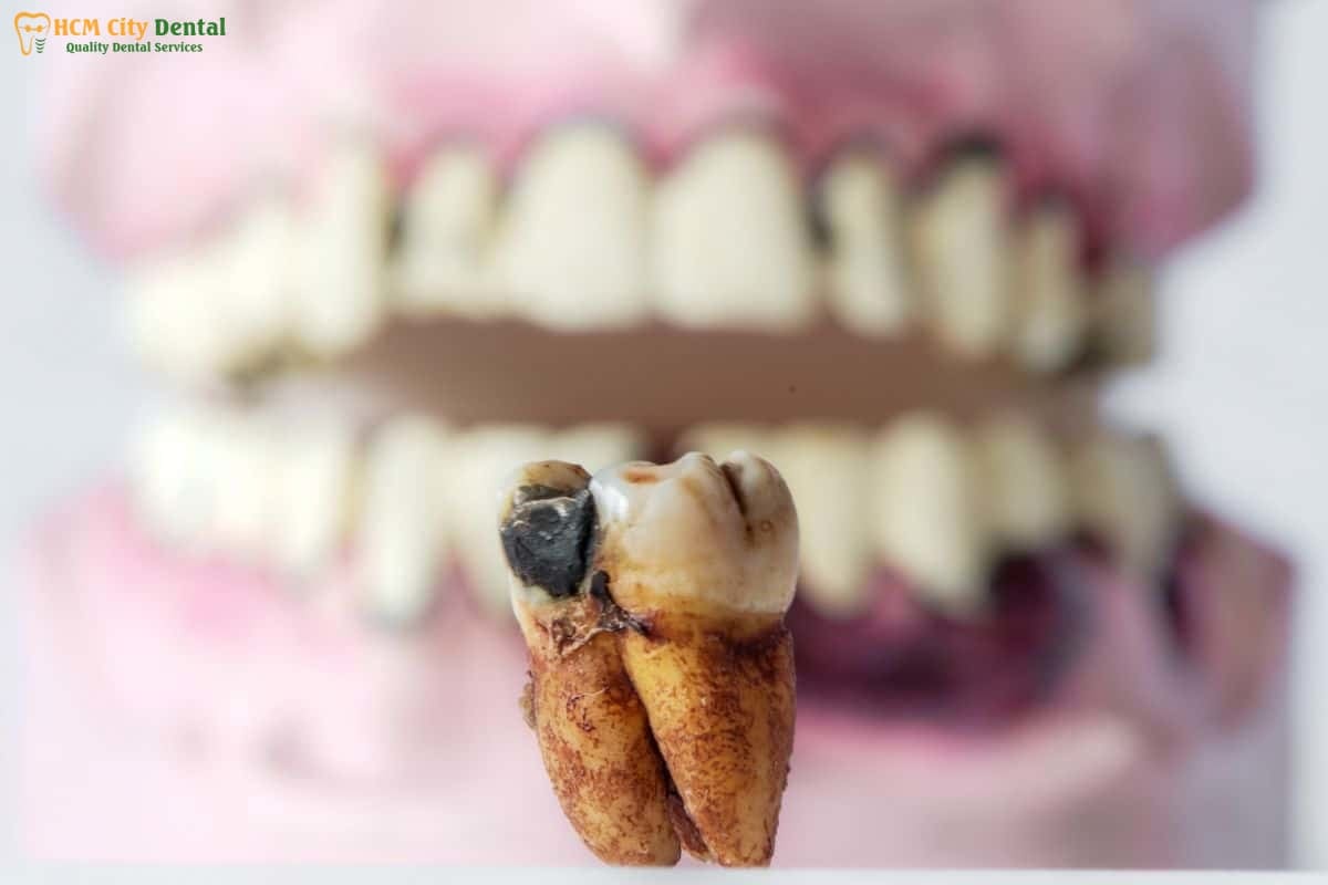 tooth-decay-and-bad-breath-6-dr-cuong-hcmc-dental-clinic-dr-cuong-hcmc-dental-clinic