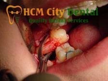 Tooth Extraction: 5 Essential Tips for a Smooth Recovery | Dr. Cuong