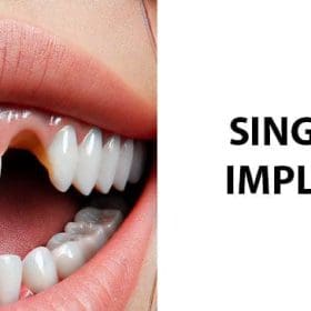Tooth Replacement Cost: [Find Your Best Option] – Dr. Cuong