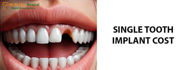 Tooth Replacement Cost: [Find Your Best Option] – Dr. Cuong