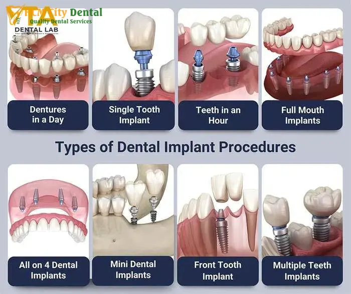 tooth-replacement-cost-2-dr-cuong-hcmc-dental-clinic-dr-cuong-hcmc-dental-clinic