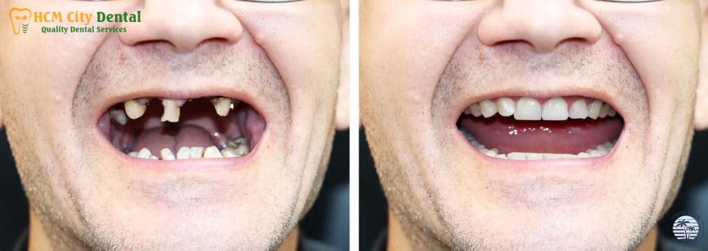tooth-replacement-cost-3-dr-cuong-hcmc-dental-clinic-dr-cuong-hcmc-dental-clinic