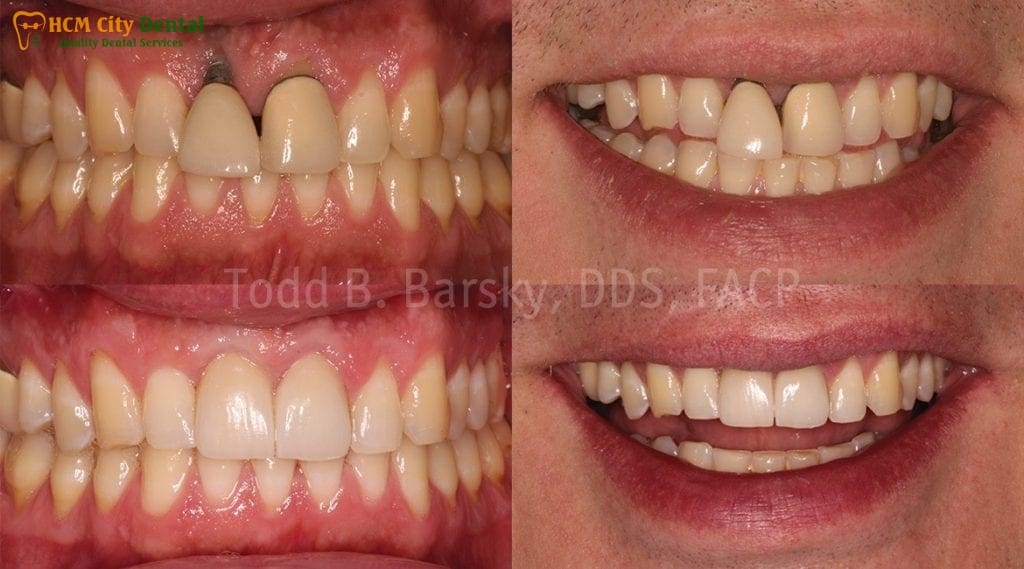 tooth-replacement-cost-5-dr-cuong-hcmc-dental-clinic-dr-cuong-hcmc-dental-clinic