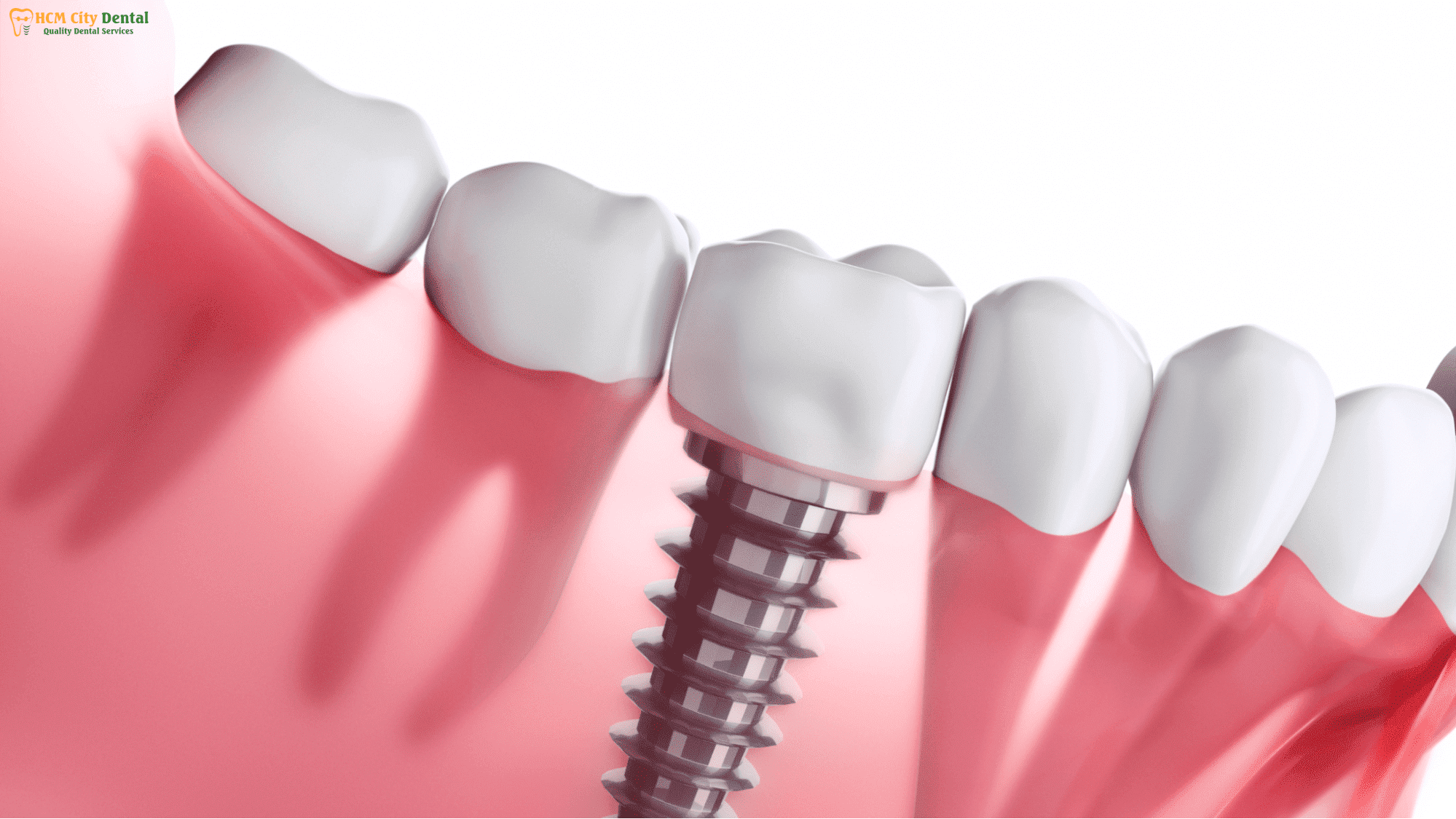 tooth-replacement-cost-6-dr-cuong-hcmc-dental-clinic-dr-cuong-hcmc-dental-clinic
