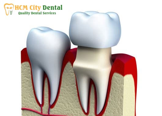 tooth-with-crown-sensitive-to-heat-2-dr-cuong-hcmc-dental-clinic-dr-cuong-hcmc-dental-clinic