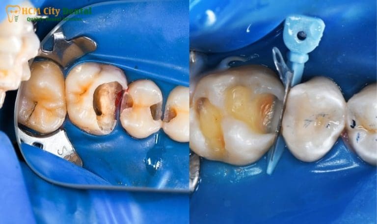 Tooth With Filling Hurts? Get Fast Relief & Fixes | Dr. Cuong