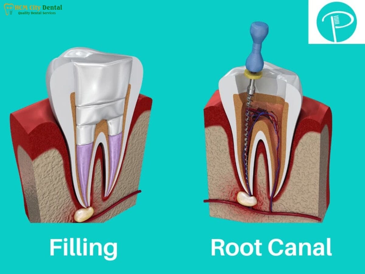 tooth-with-filling-hurts-2-dr-cuong-hcmc-dental-clinic-dr-cuong-hcmc-dental-clinic