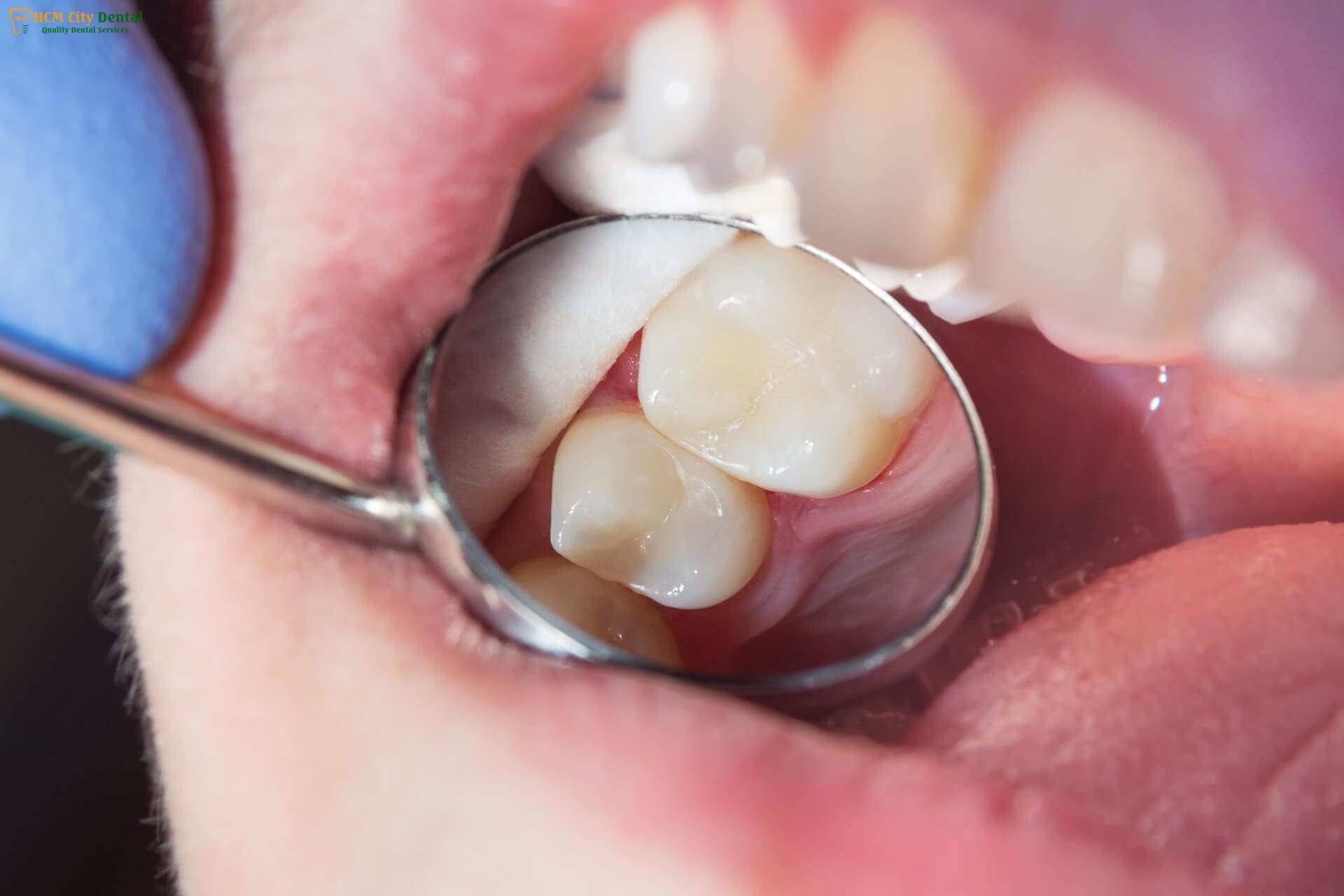 tooth-with-filling-hurts-3-dr-cuong-hcmc-dental-clinic-dr-cuong-hcmc-dental-clinic