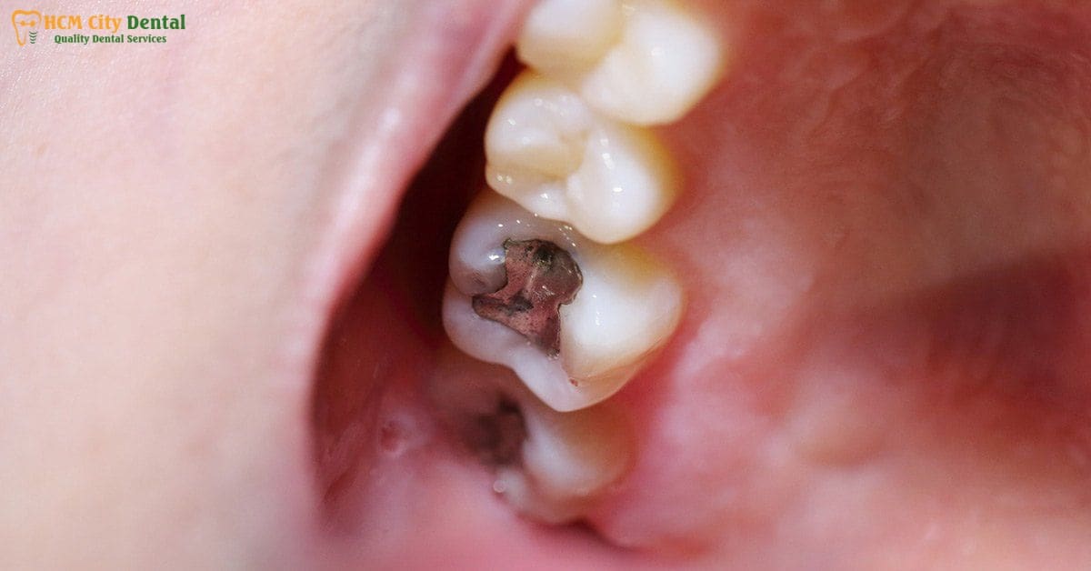 tooth-with-filling-hurts-4-dr-cuong-hcmc-dental-clinic-dr-cuong-hcmc-dental-clinic