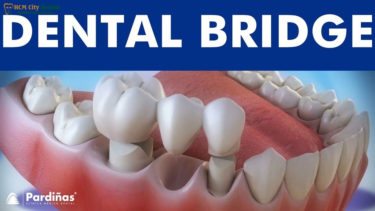 What is a Fixed Bridge Dental? [Full Guide] | Dr. Cuong