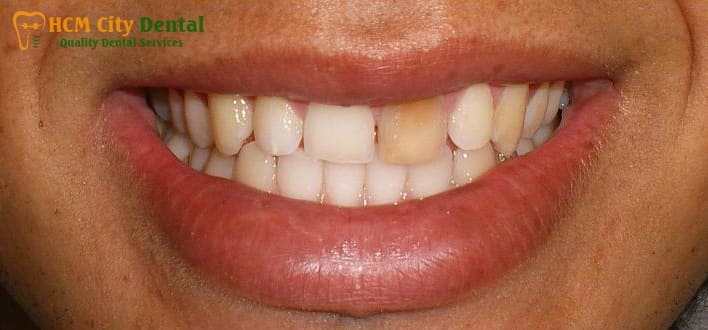 what-to-do-with-a-dead-tooth-2-dr-cuong-hcmc-dental-clinic-dr-cuong-hcmc-dental-clinic