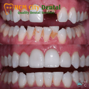 what-to-do-with-a-dead-tooth-5-dr-cuong-hcmc-dental-clinic-dr-cuong-hcmc-dental-clinic