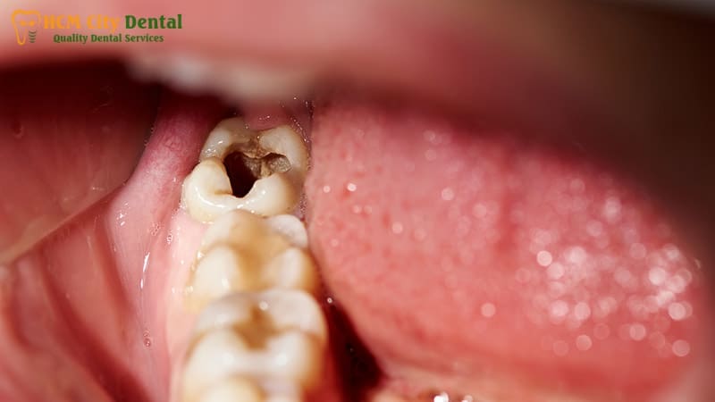 what-to-do-with-a-dead-tooth-6-dr-cuong-hcmc-dental-clinic-dr-cuong-hcmc-dental-clinic