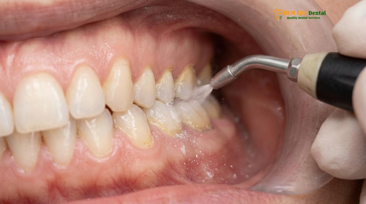 Visual description of airflow teeth cleaning price saigon
