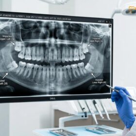 All 4 Wisdom Teeth Removed at Once: Clinical Guide | HCMC Dental