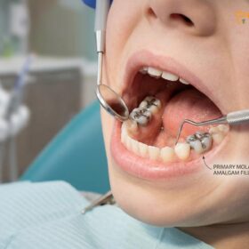 Remove Silver Fillings Safely in Children: Clinical Guide