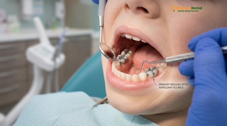 Remove Silver Fillings Safely in Children: Clinical Guide