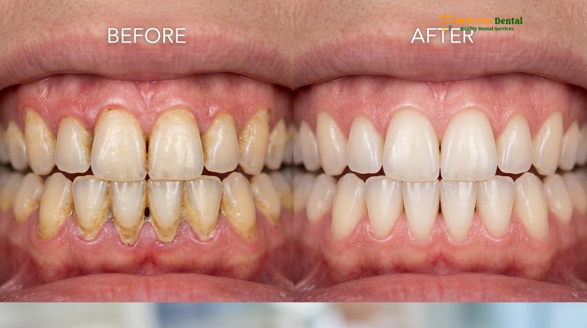 Visual illustration of average price for dental cleaning