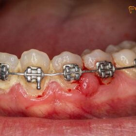 Bad Braces: Clinical Risks, Complications & Retreatment | HCMC Dental
