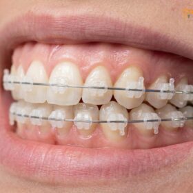 Best Food for Braces: Clinical Orthodontic Diet Guide | HCMC Dental
