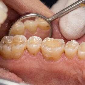 Best Night Guard for Heavy Grinding: Clinical Guide | HCMC Dental