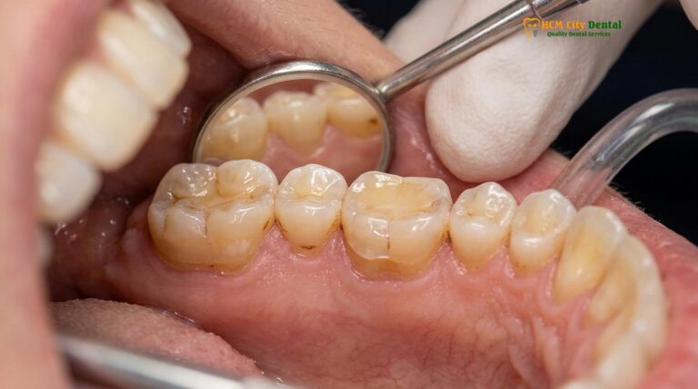 Best Night Guard for Heavy Grinding: Clinical Guide | HCMC Dental