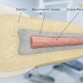 Bioceramic Root Canal Sealer: Clinical Guide | HCMC Dental