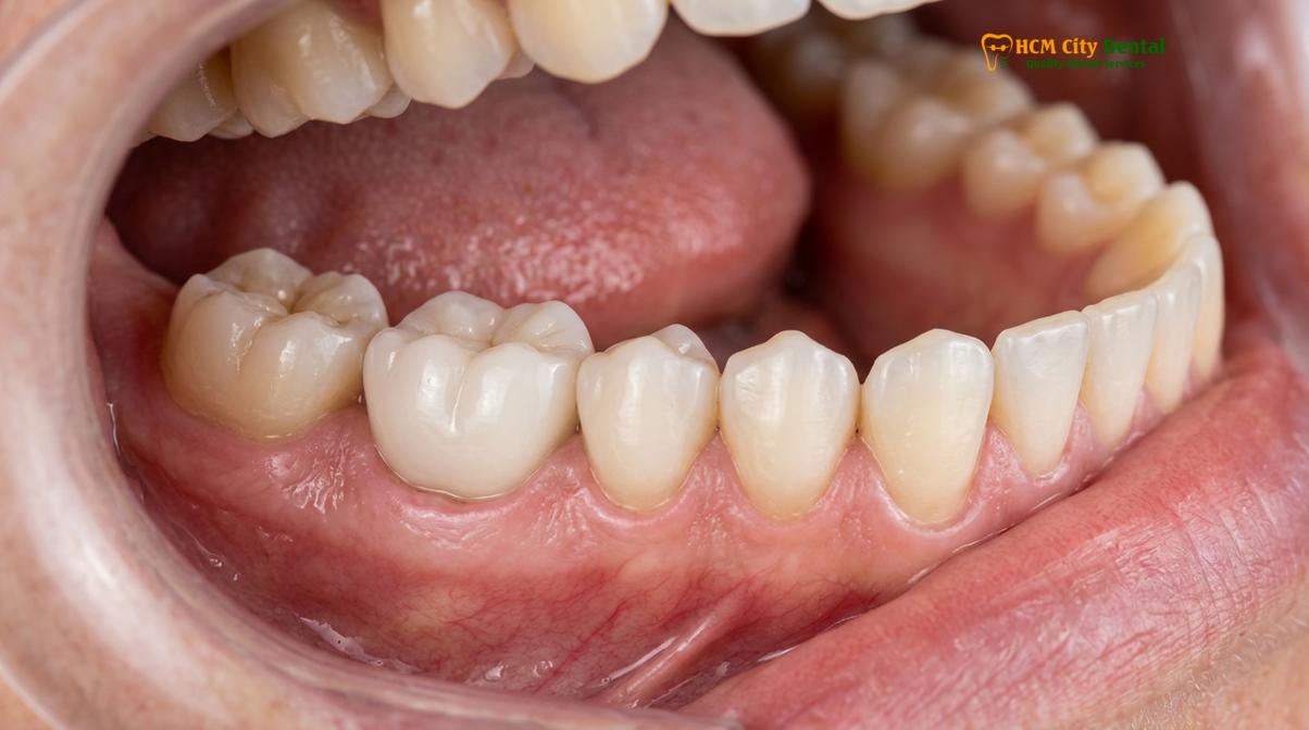 Clinical photography related to biological dentist cost Vietnam