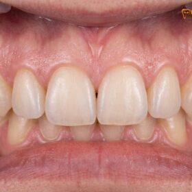 Bone Graft & Gum Graft for Full Mouth Rehabilitation: Clinical Guide
